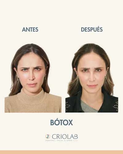 Botox Party:  The Private Experience by Criolab